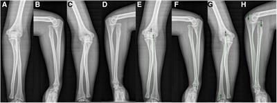 Bilateral anterior congenital radial head dislocation in adults: a case report and literature review